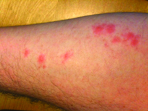 Bed Bug Bites, Rashes & Symptoms