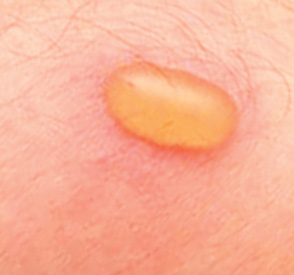 What does a blister bug bite look like? | Reference.com