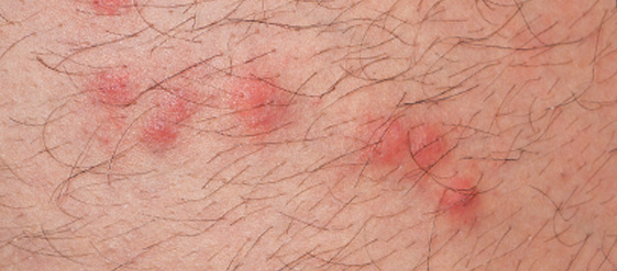 Flea Bites & Treatment What Do Flea Bites Look Like on Humans