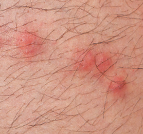 Flea Bite in Adults: Condition, Treatments, and Pictures ...