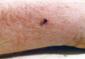 Tick on Human Arm