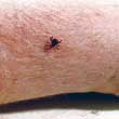 Tick on a Person