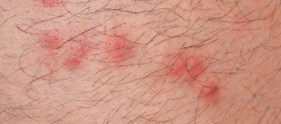 How To Identify Treat Flea Bites On Humans Orkin